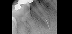 ユーズ大阪根管治療専門歯科医院 根管治療 症例5 治療用器具破折の除去ケース 